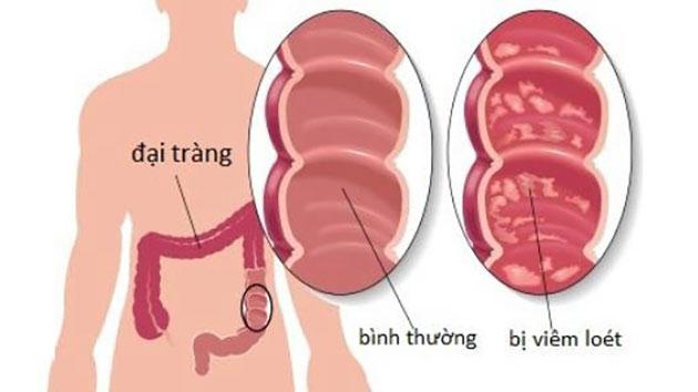 Thiếu máu cục bộ đại tràng