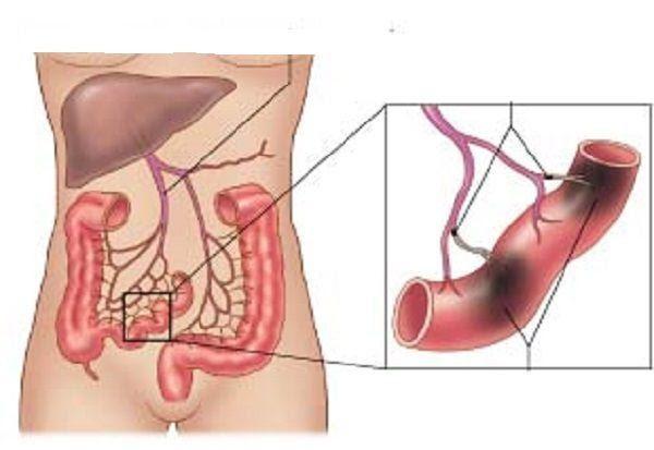 Thiếu máu cục bộ đại tràng