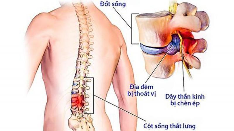 Thoái hóa Cột sống