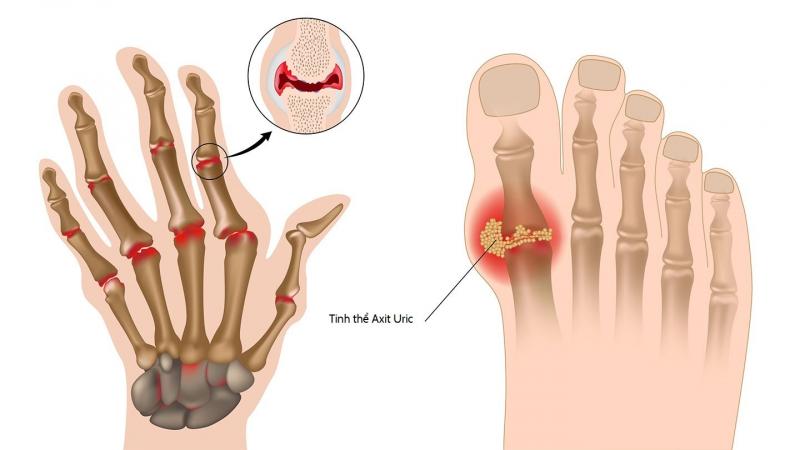 Bệnh Gout là gì?