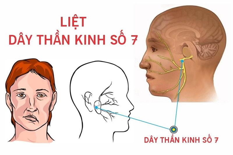 ThS.BS Nguyễn Văn Thái chữa liệt dây thần kinh số 7 (Liệt mặt) giỏi, giàu kinh nghiệm nhất tại Tp.HCM