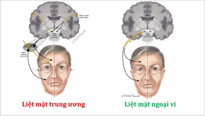 ThS.BS Phạm Quỳnh Nga chữa liệt dây thần kinh số 7 (Liệt mặt) giỏi, giàu kinh nghiệm nhất tại Tp.HCM