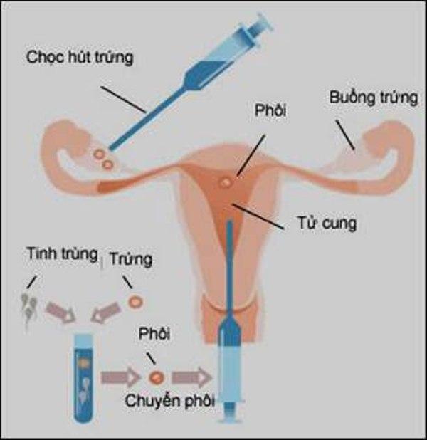 Quá trình thụ tinh ống nghiệm