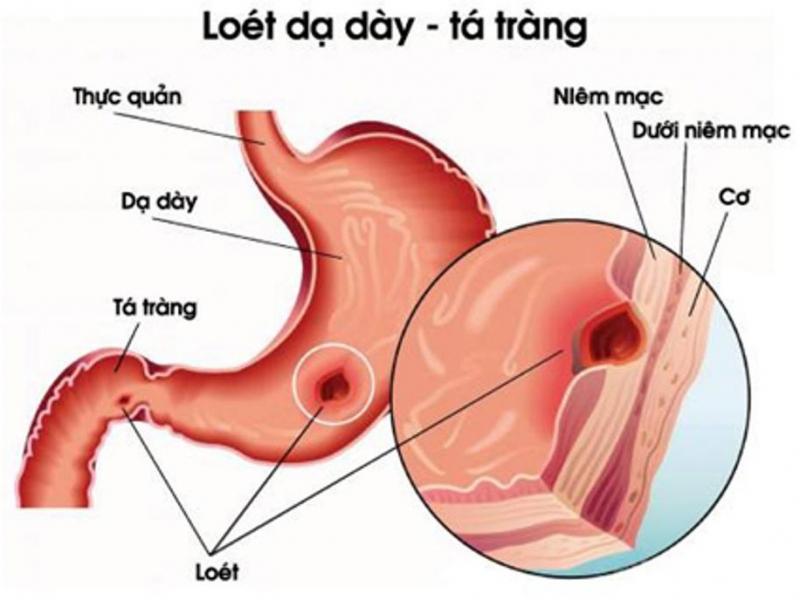 Thủng dạ dày tá tràng