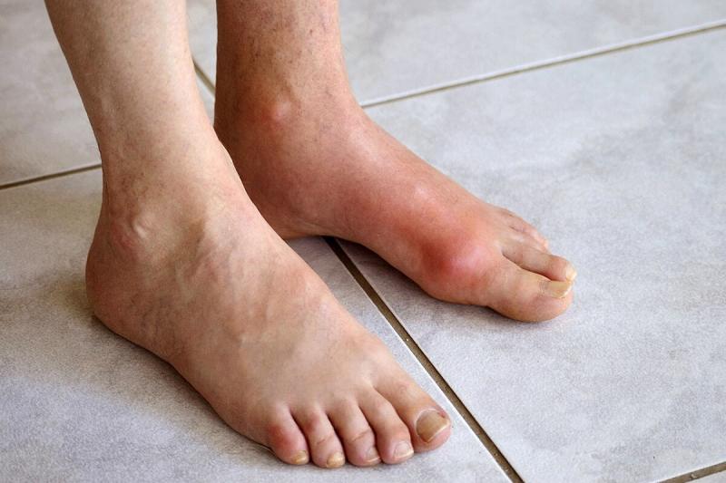 Các đối tượng có nguy cơ bị Gout