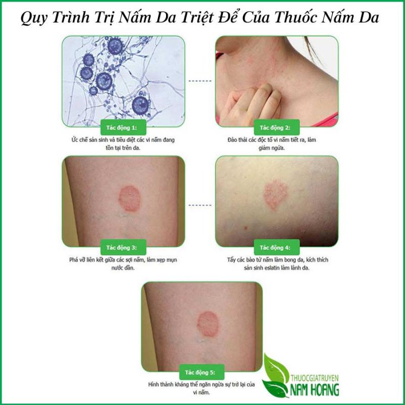 Thuốc Trị Nấm Da Đông Y Gia Truyền Nam Hoàng