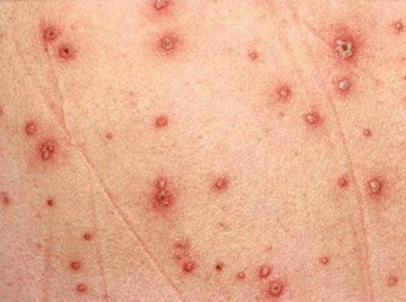 Bệnh thủy đậu là bệnh truyền nhiễm cấp tính do virus thủy đậu có tên Varicella virus gây ra