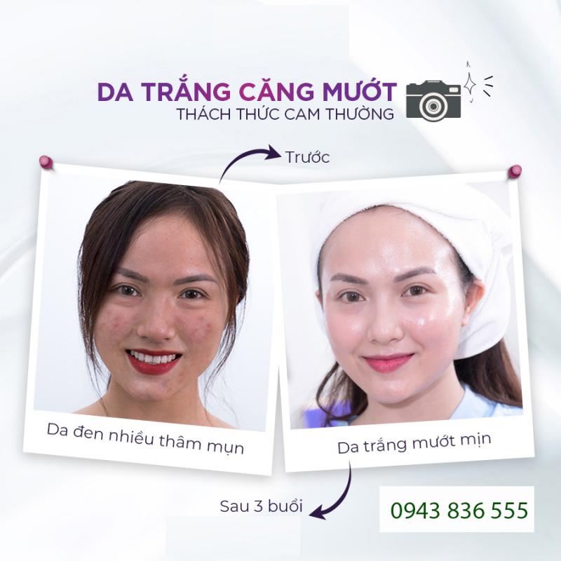 Spa trị mụn hiệu quả nhất quận Long Biên, Hà Nội