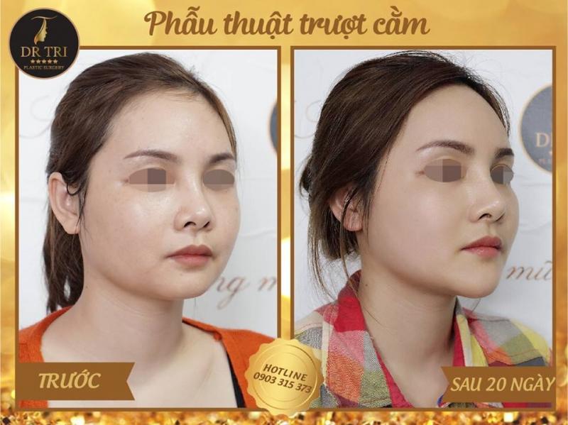 Hiệu quả trong thấy sau khi được trượt cằm tại Tiến Sĩ Bác Sĩ Đỗ Thành Trí - Phẫu thuật Thẩm mỹ