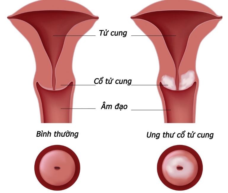 Người có tiền sử mắc bệnh ung thư cổ tử cung có nguy cơ cao mắc bệnh ung thư đại tràng