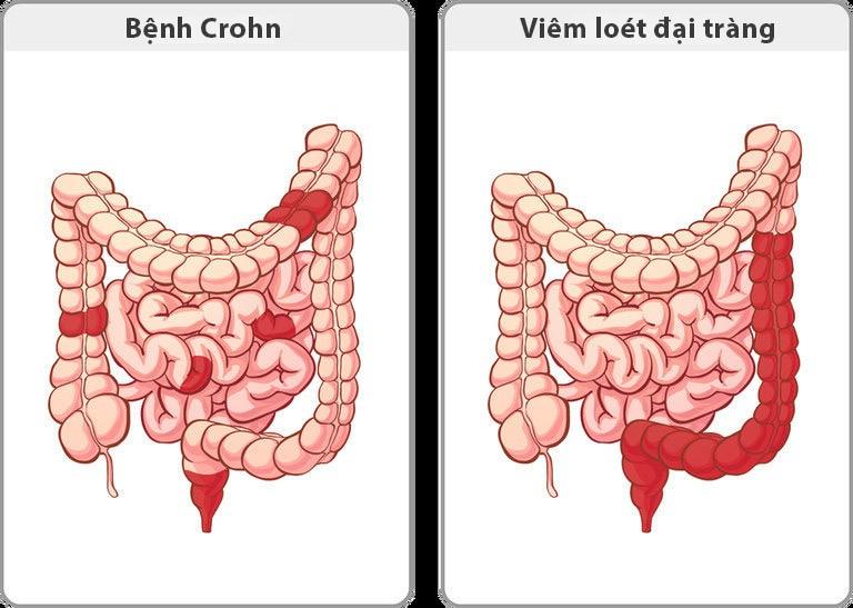 Tiền sử mắc bệnh viêm đường ruột