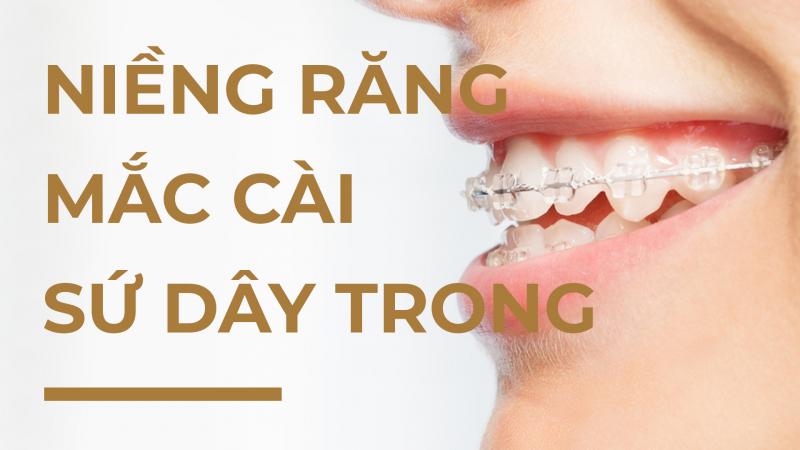 Tổng quan về niềng răng mắc cài sứ dây trong