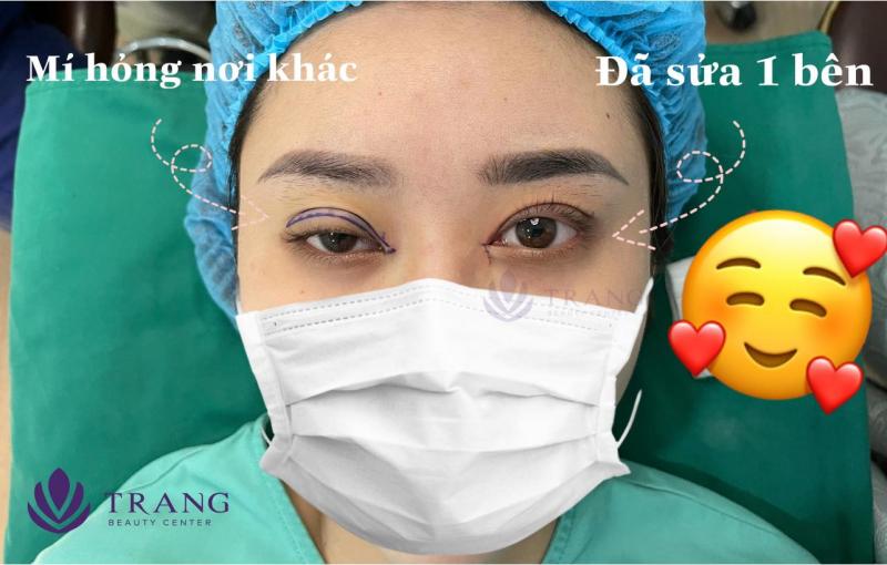 Khách hàng trước và sau khi cắt mí tại Trang Beauty Center