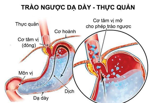 Trào ngược dạ dày