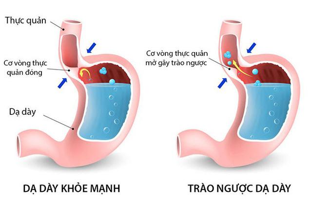 Trào ngược dạ dày thực quản