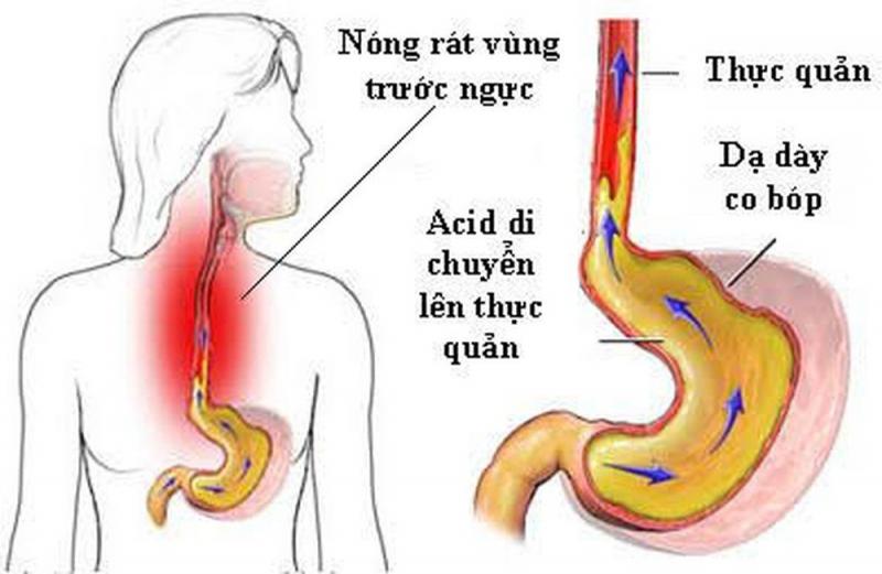 Trào ngược dạ dày thực quản