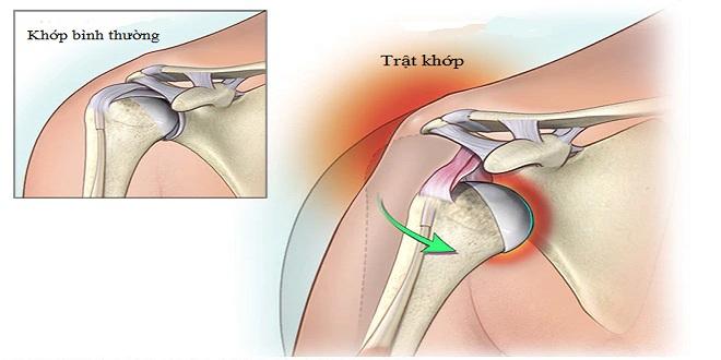 Trật khớp vai là tình trạng các khớp trên vai của bạn trở nên lỏng lẻo, có thể dịch chuyển theo những hướng khác nhau rất bất thường.