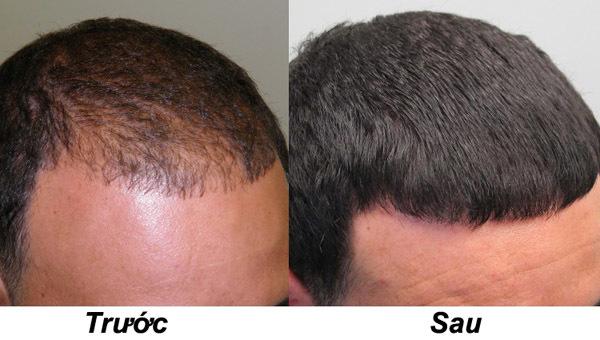 Trị hói đầu bằng liệu pháp laser mức độ thấp (LLLT)