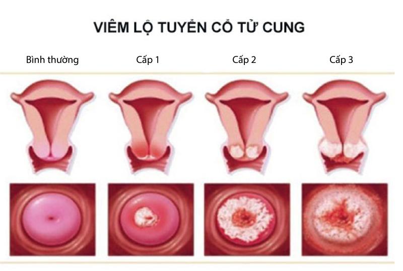 Triệu chứng viêm lộ tuyến tử cung