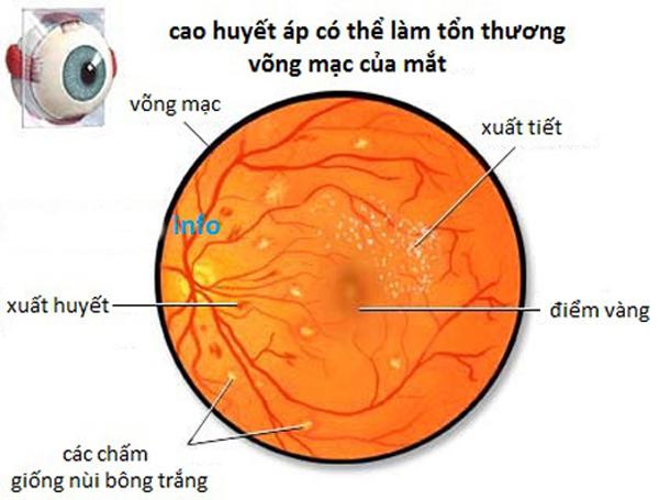 Ảnh hưởng của tăng huyết áp trên mắt