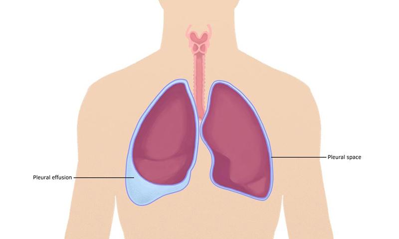 Viêm màng phổi có thể đi kèm với tràn dịch màng phổi