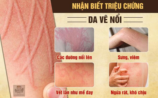 Top 8 Lưu ý quan trọng nhất về bệnh da vẽ nổi - toplist.vn