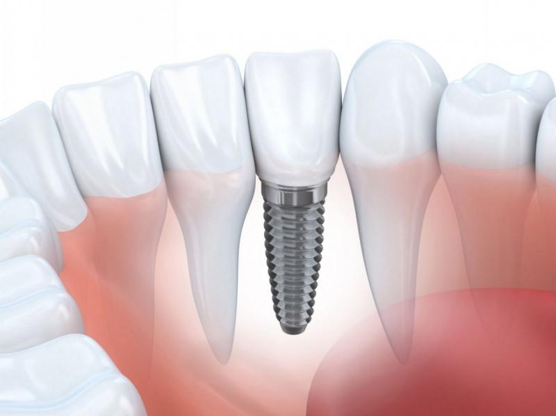 Phương pháp trồng răng Implant