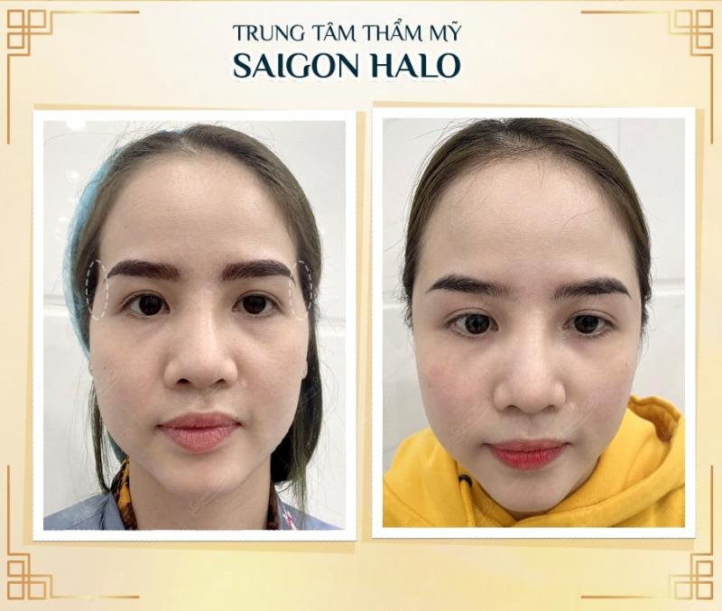 Viện Thẩm Mỹ Sài Gòn Halo