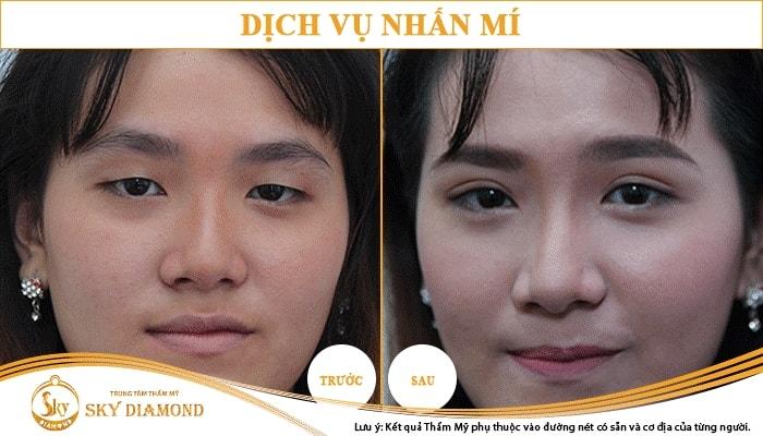 Trung Tâm Thẩm Mỹ Sky Diamond - địa chỉ nhấn mí mắt đẹp và an toàn nhất ở TP. HCM