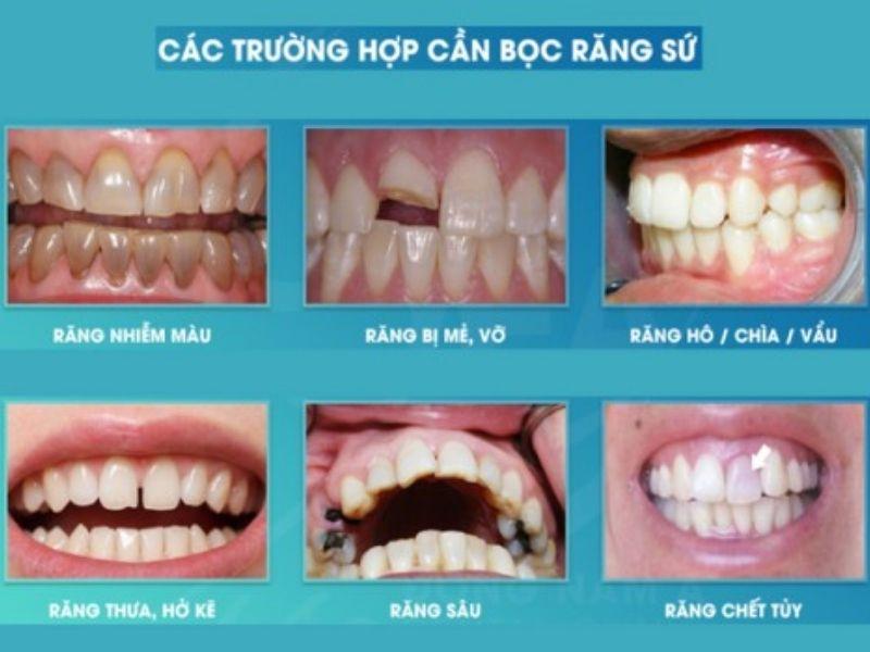 Trước đây, bọc răng sứ chỉ được chỉ định cho 