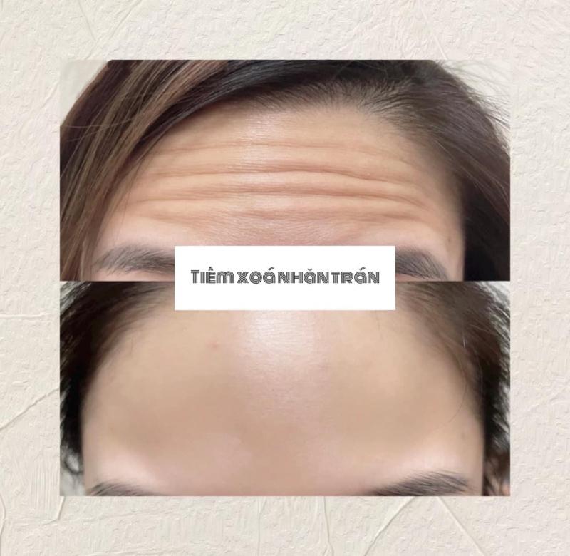 Tuấn Vũ Filler - Botox