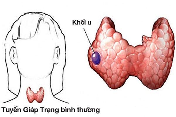 U tuyến giáp lành tính