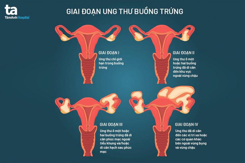 Các giai đoạn của ung thư buồng trứng