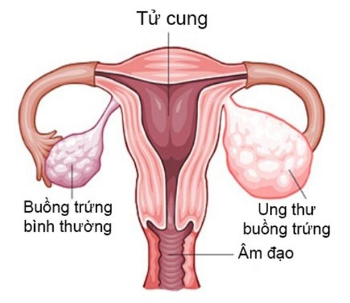 Buồng trứng trái bình thường và buồng trứng phải ung thư