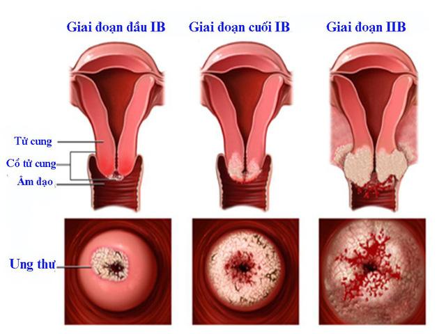 Ung thư cổ tử cung