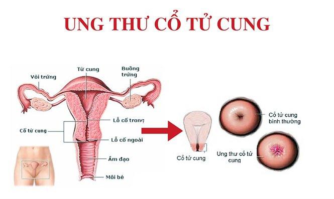 Ung thư cổ tử cung là do các tế bào ở cổ tử cung (phần dưới của tử cung) bắt đầu phát triển vượt quá mức kiểm soát của cơ thể gây ra.