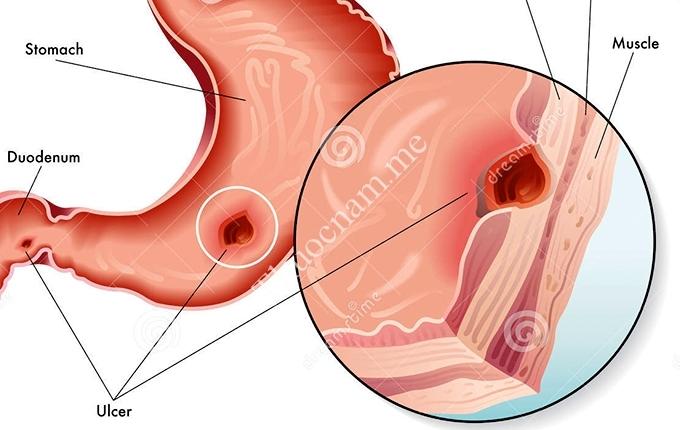 Các bệnh lý về dạ dày rất dễ dẫn đến ung thư dạ dày.