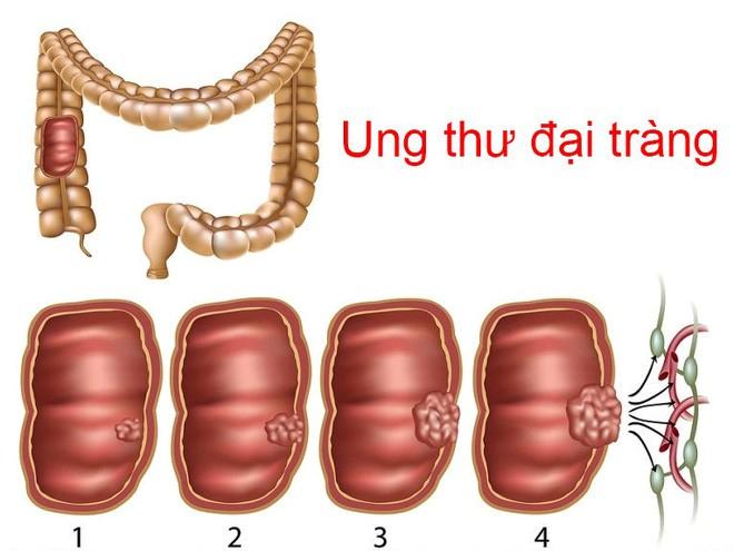 Ung thư đại tràng