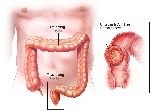 Ung thư đại trực tràng rất phổ biến ở nữ giới