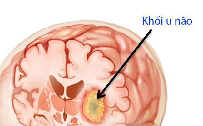 Ung thư não là căn bệnh vô cùng nguy hiểm