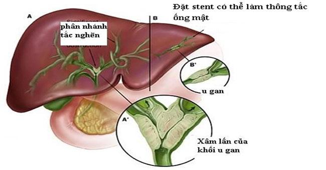 Ung thư ống mật