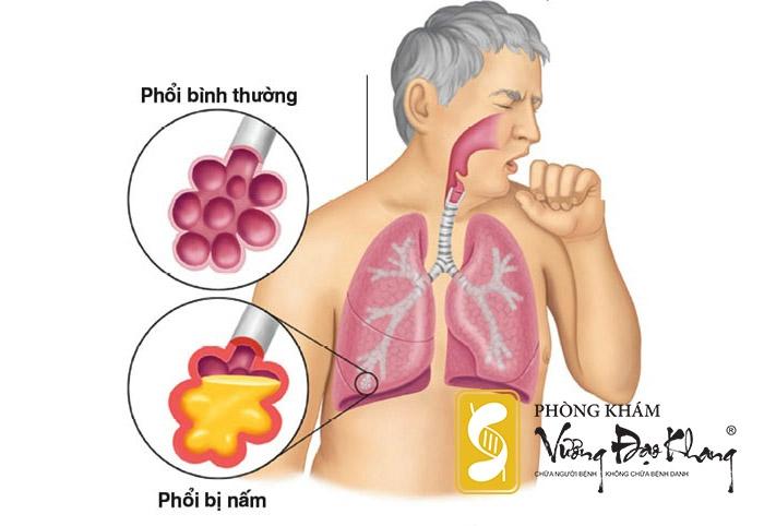 Hút thuốc lá dễ mắc rất nhiều bệnh ung thư đặc biệt là Ung thư phổi.