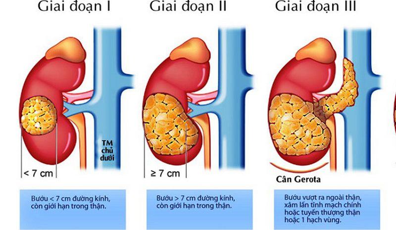 Các giai đoạn ung thư thận