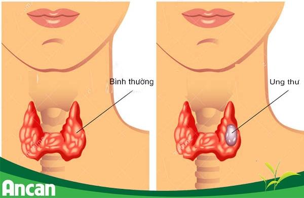 Ung thư tuyến giáp dễ phát hiện nên chúng ta có thể thường xuyên kiểm tra vùng cổ.