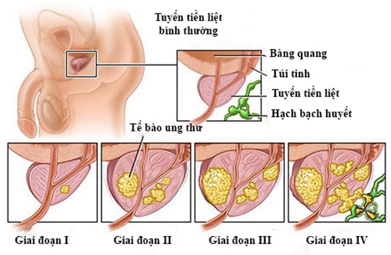 Tuyến tiền liệt và các giai đoạn ung thư của tuyến