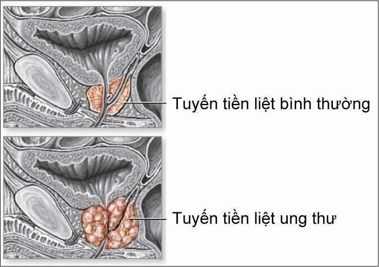 Hình ảnh của tuyến tiền liệt bị ung thư