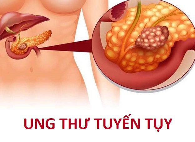 Ung thư tuyến tụy