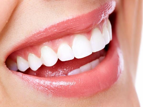 Ưu điểm của răng sứ Veneer