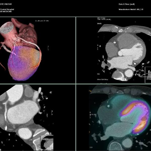 Ứng dụng PET/CT đối với bệnh tim