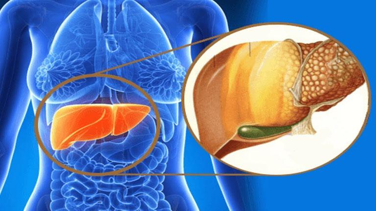 Bệnh nhân mắc gan nhiễm mỡ không nên ăn chế độ Ketogenic